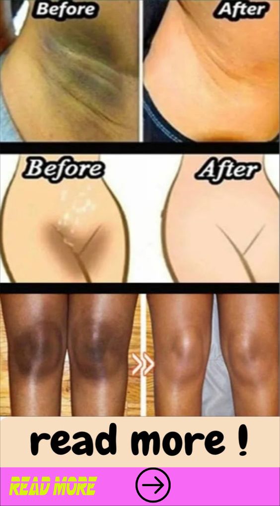 How to lighten dark inner thighs naturally