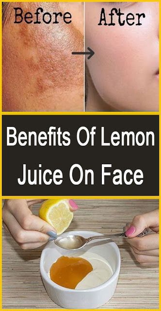 How To Remove Pigmentation From Face Permanently at Home