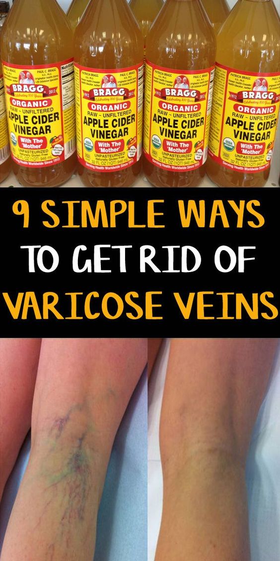 How to Get Rid of Varicose Veins Naturally DIY Health Tips