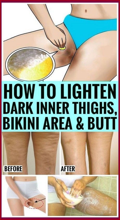 How To Get Rid Of Dark Inner Thighs Naturally