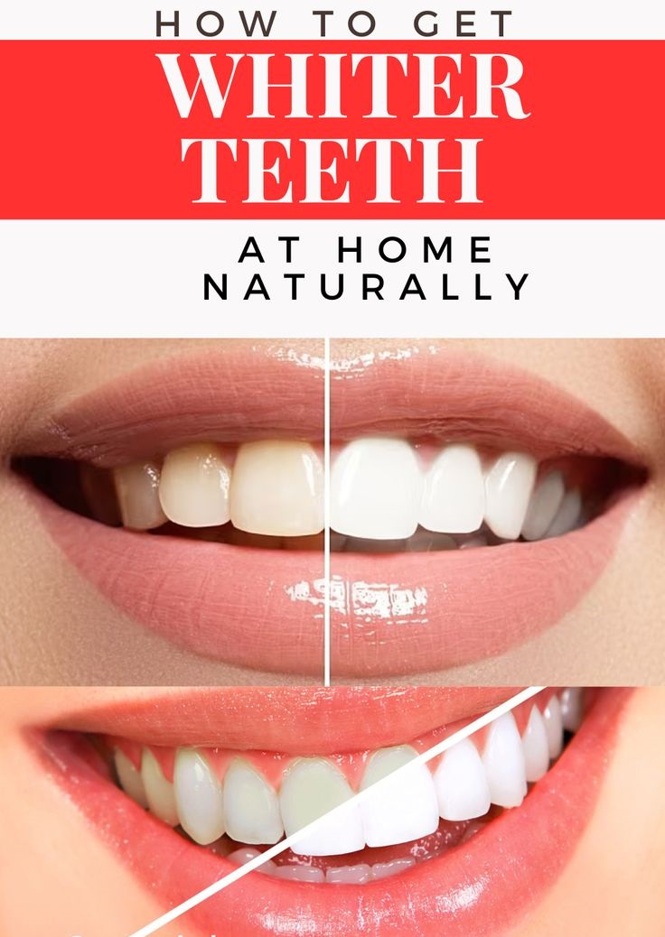 How to Get Whiter Teeth at Home Naturally