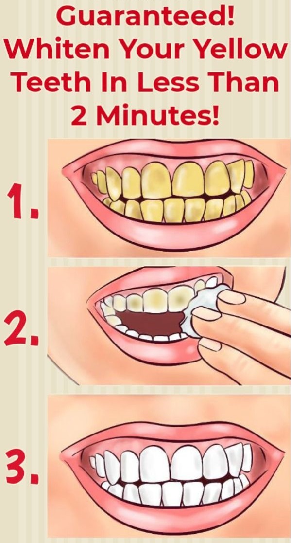 Guaranteed! Whiten Your Yellow Teeth In Less Than 2 Minutes!